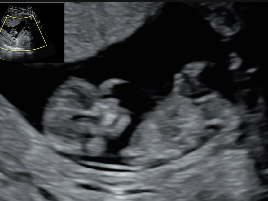 rv11 kehitys on huimaa