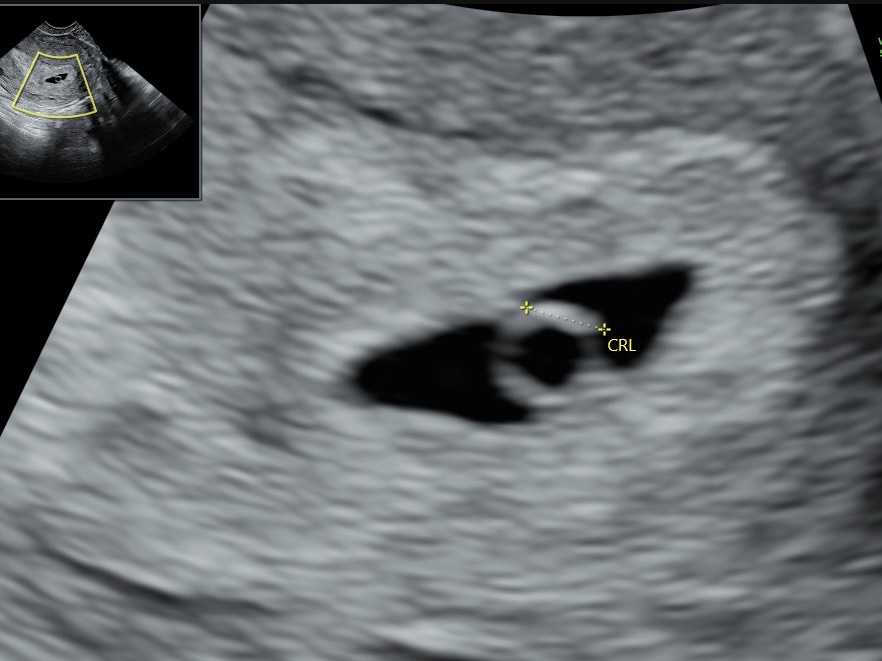 rv5+6, sikiö täplänä ruskuaisrenkaassa